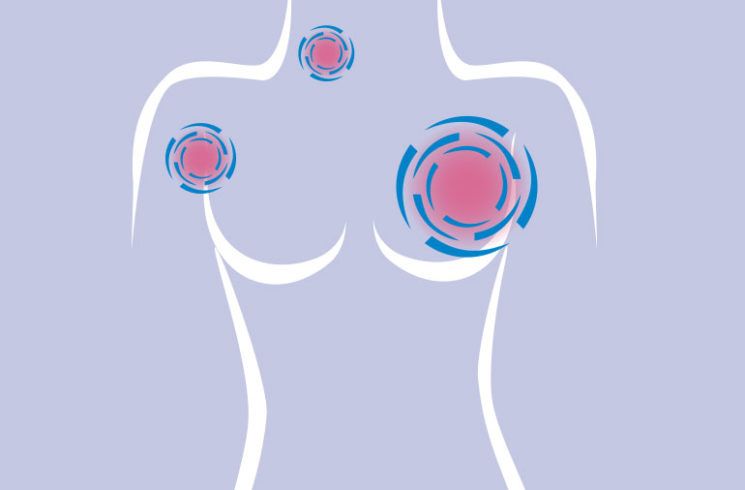 Cleveland Clinic: autoexploración y revisión médica, pilares en la lucha contra el cáncer de mama